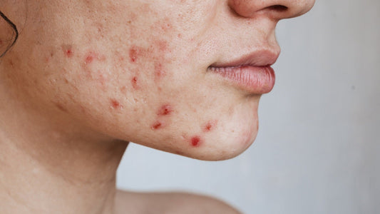 Managing Acne Breakouts: Natural Oils for Clear Skin - Trehi Organics
