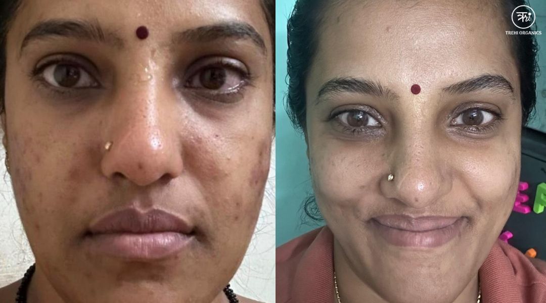 My Acne Scars Didn't Just Change My Skin. They Changed My Life. - Trehi Organics