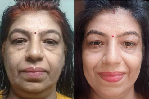 Sarika - Puffiness before and after