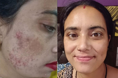 Deepika - Acne-prone skin before and after