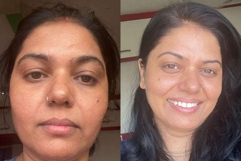 Deepali - Jawline & puffiness before and after