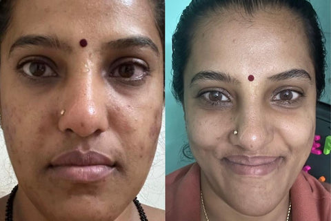 Suma - Pigmentation before and after